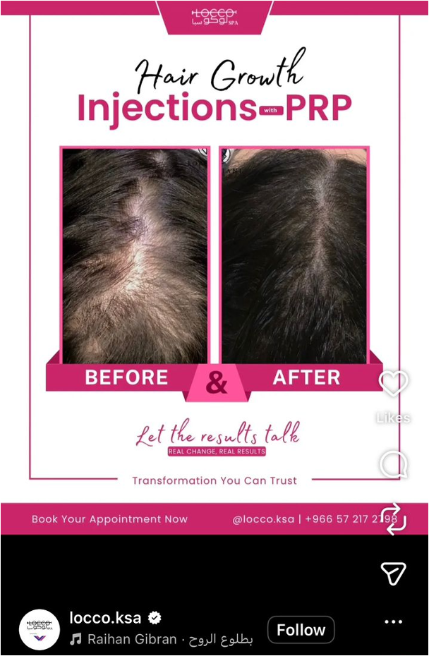 Before-and-after feed ad using a clear split-screen comparison to show the visible result of a hair growth treatment.